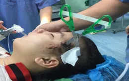 Cứu bé gái 10 tuổi bị bạn đâm kéo vào đầu thủng xương sọ