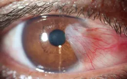 Chăm sóc mắt bị mộng thịt