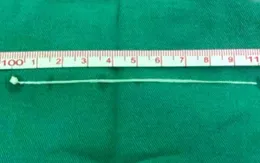 Đau đầu suốt 30 năm vì sán dây trong não