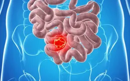 Các dấu hiệu cảnh báo bệnh viêm đại tràng co thắt