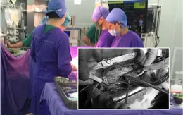 Xuyên đêm cấp cứu bệnh nhân vỡ tim do tai nạn giao thông