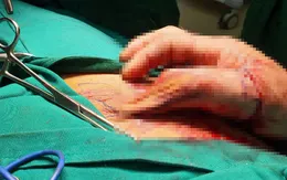 Dập nát ngón tay do máy ép gạch
