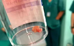 Hạt đậu phộng "cư trú" 2 tháng trong phổi bé gái, gây nhầm tưởng là hen suyễn