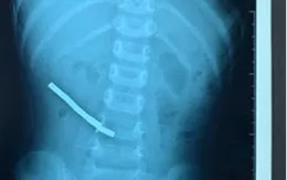Bé 3 tuổi chướng bụng suốt 9 ngày vì nuốt... 6 thỏi nam châm, 3 kim bấm