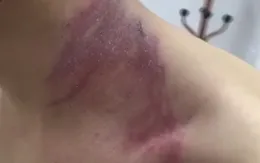 Cách phòng tránh tổn thương da do kiến ba khoang