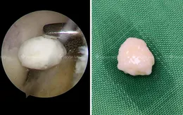 Loại bỏ mảnh sạn gây kẹt khớp gối