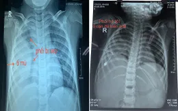 Hai bệnh viện nhi phối hợp cứu bé 5 tuổi tràn mủ, dính màng phổi phức tạp