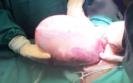 Sản phụ sinh đôi, 1 bé còn nguyên túi ối