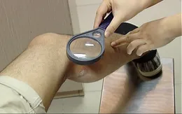 Gần 100 người đến khám mỗi ngày vì tiếp xúc với kiến ba khoang