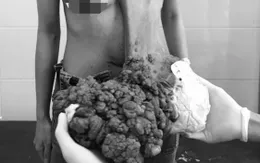 Loại bỏ u khủng nặng 10kg đeo đẳng trên người cô gái 29 tuổi hàng chục năm
