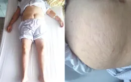 Lạm dụng corticoid - Tiền mất tật mang