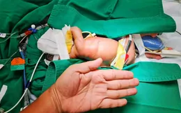 Hai ca mổ sửa đa dị tật đường tiêu hóa cho bé gái sinh non tháng mắc tim bẩm sinh