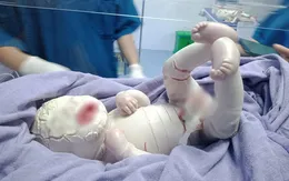 Bé sơ sinh chào đời với lớp sừng dày, nứt thành kẽ sâu