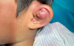 Phẫu thuật áp xe vành sụn tai cho bé trai ở vùng lũ Quảng Trị