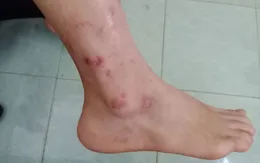 Biến chứng da do tùy tiện dùng Corticoid bôi ngoài da