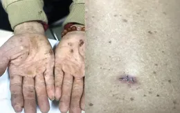 Cảnh báo ung thư da do nhiễm độc thạch tín