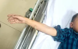 Nô đùa sau khi ăn, bé 6 tuổi bị xiên que đâm xuyên cẳng tay