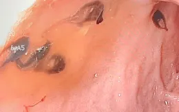 Nội soi gắp... 50 con sán lá gan trong đường mật bệnh nhân