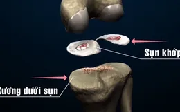 Giải pháp mới hỗ trợ điều trị bệnh xương khớp