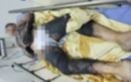 Bé trai bỏng nặng do tự dùng cồn làm thí nghiệm tại nhà