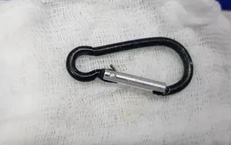 Gắp móc chìa khóa trong dạ dày bé 20 tháng tuổi