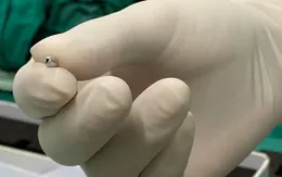 Lấy hạt cườm nằm cả tháng trong ống tai bé 2 tuổi