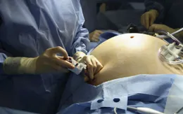 Từ "quá khổ" thành suy dinh dưỡng vì bác sĩ cắt dạ dày quá tay