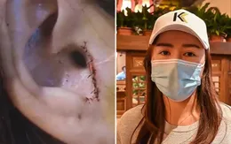 Người phụ nữ Trung Quốc bị mất một phần tai sau khi phẫu thuật mũi
