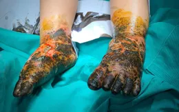 Đắp thuốc nam chữa bỏng, hai bàn chân bé trai bị nhiễm trùng nặng