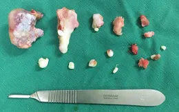Lấy bỏ gần 20 hạt sụn trong... khớp cổ chân