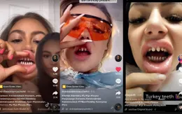 Xu hướng mài răng trên TikTok: Thẩm mỹ hay rủi ro sức khoẻ?