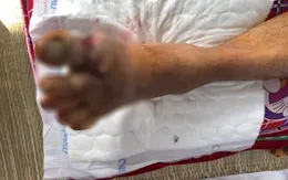 Nối bàn chân gần đứt rời do máy cắt cỏ chém vào