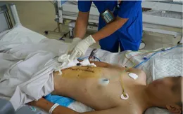 Cứu nam bệnh nhân sốc mất máu, vỡ gan phức tạp do tai nạn giao thông
