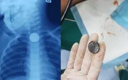 Bé 2 tuổi bỏng thực quản do nuốt pin cúc áo