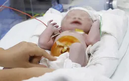Cứu trẻ mắc tim bẩm sinh nặng ngay khi chào đời