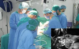 Phẫu thuật cắt gan - Lựa chọn điều trị triệt để ung thư gan