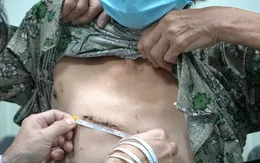 Lần đầu tiên tại Việt Nam: Áp dụng kỹ thuật phẫu thuật tim xâm lấn tối thiểu