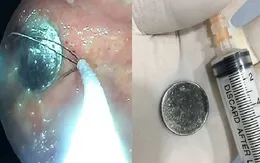 Gắp đồng xu trong dạ dày bé gái 4 tuổi