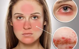 Chương trình nghiên cứu gene quy mô lớn về bệnh lupus ban đỏ tại châu Á