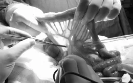 Ghép nối ruột tái tạo đường ăn cho người bệnh ung thư thanh quản hạ họng