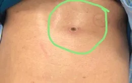 Hòa Bình: 1 bệnh nhân suy đa tạng do mò đốt