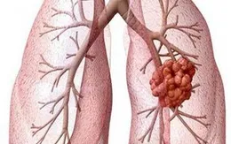 Liệu pháp nhắm trúng đích trong điều trị ung thư phổi