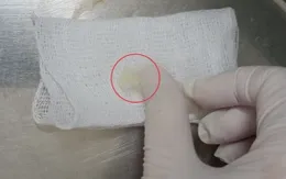 Học theo trò chơi trên mạng, bé gái 4 tuổi phải nhập viện lấy dị vật trong mũi