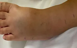 Chơi ở vườn nhà, bé 4 tuổi bị rắn lục đuôi đỏ tấn công