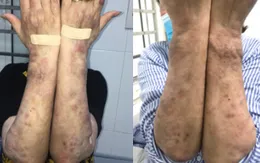 "Hãy hành động ngay: Chấm dứt bệnh phong"