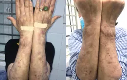 Hà Nội: Xuất hiện ca bệnh phong thể nhiều vi khuẩn, giống với Lupus ban đỏ hệ thống