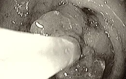 Xuất huyết tiêu hóa, hẹp môn vị do bã thức ăn