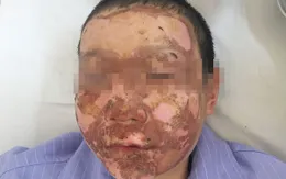 Nhiều trẻ nhập viện do bỏng cồn, pháo tự chế