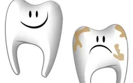 Những thói quen không tốt làm tổn thương răng