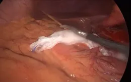 Cứu sống bệnh nhân bị tăm tre đâm thủng dạ dày và gan
